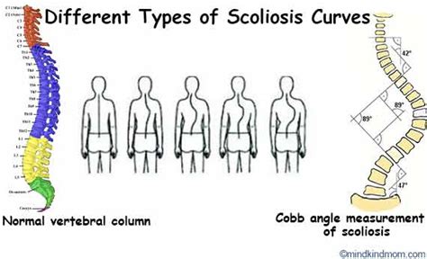 Different Curves - Understanding Spinal Misalignments - MindKind Mom