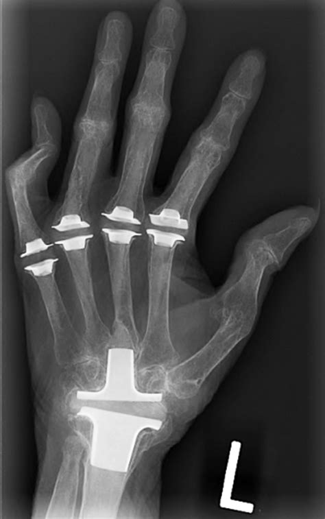 Medical Apparatus Imaging Guide: joint arthroplasty