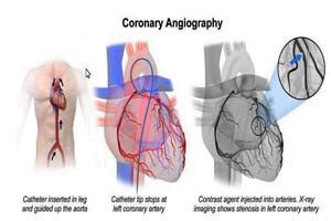 Coronary Angiography Test COST India | TOP Hospitals Angiography Surgery