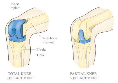 The Differences between Partial and Total Knee Replacement | Knee Replacement Costs