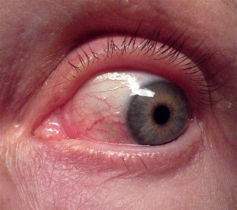 Conjunctivitis: Allergic, infectious or chemical? www.advancedoptometry.net