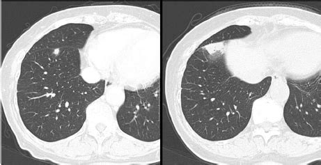 (a) Chest CT showing a small nodule in right lung, S8; (b) two months... | Download Scientific ...