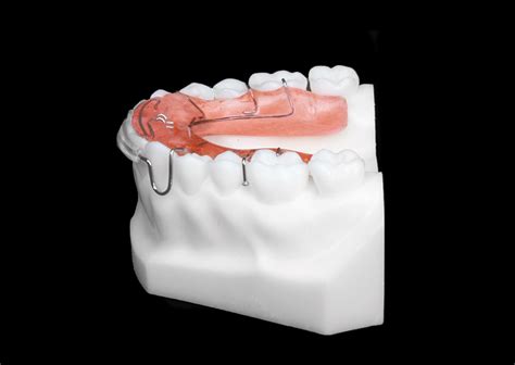 Standard Spring Retainer (Lower) - Universal Orthodontic Lab