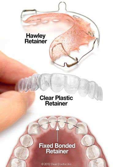 Types of Dental Retainers | Newmarket Dentists | Davis Dental Care