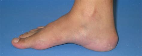 Pes Cavus Foot Definition, Causes, Symptoms, Diagnosis