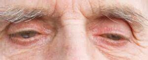 Sagging Eye Syndrome: Causes, Symptoms, Diagnosis & Treatment - Daily Medicos