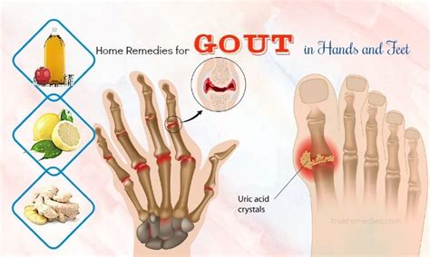 37 Home Remedies For Gout In Hands And Feet