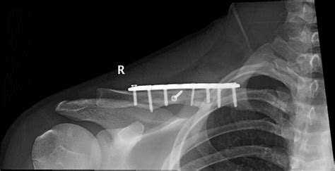 Clavicle Plating System | Acumed