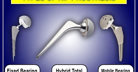 TYPES OF HIP PROSTHESIS