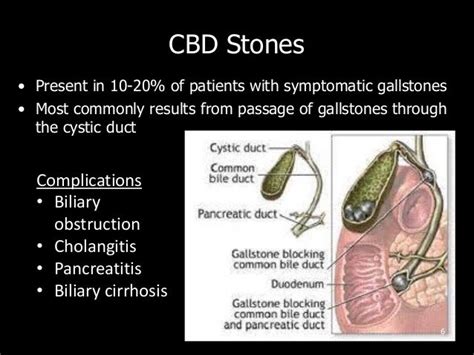 Approach to Common Bile Duct Stones