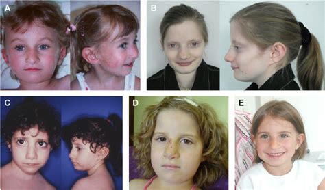 Photographs of patients, showing facial characteristics of... | Download Scientific Diagram