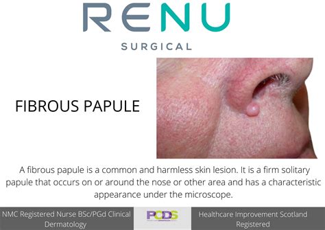 FIBROUS PAPULE | Renu Skin Clinic