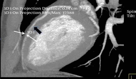 Systolic Compression of a Myocardial Bridged Coronary Artery and its ...