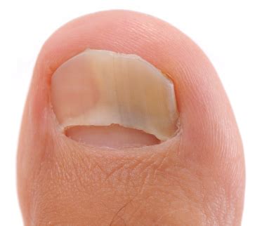 Prevent Toenail Fungus | Atlanta | American Foot & Leg Specialists