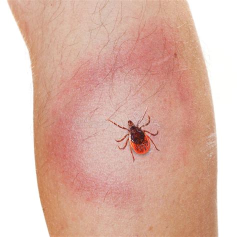 Tick on Human Leg. Dangerous Parasite on Human Skin. Stock Photo ...