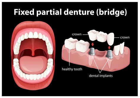 Cracked Root Canal Tooth | Causes, Symptoms, Treatment, and Prevention - HEALTH SUPPORT