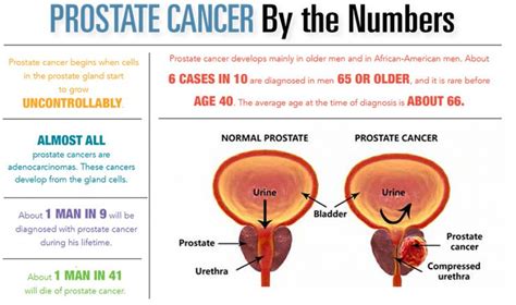 Hope for Prostate Cancer - Upstate Physicians