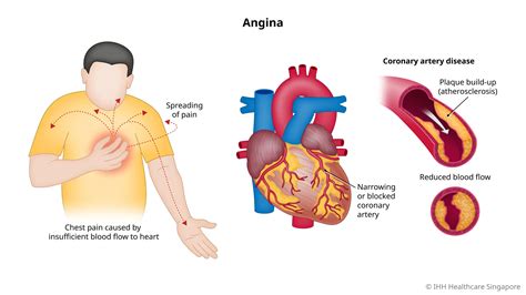 Angina Pectoris (Chest Pain) - Symptoms & Causes | Mount Elizabeth ...