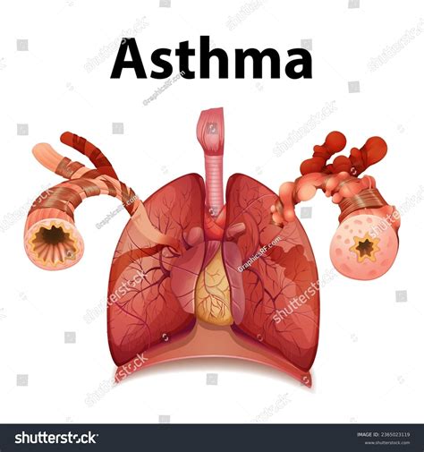 Informative Infographic Comparing Normal Asthma Lungs Stock Vector ...