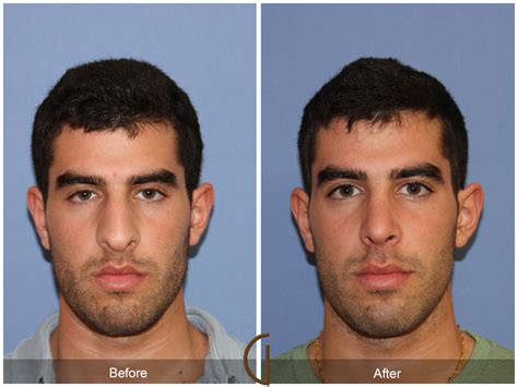 Turbinate Nasal Surgery | Gallery Of Cosmetic Surgery Orange County