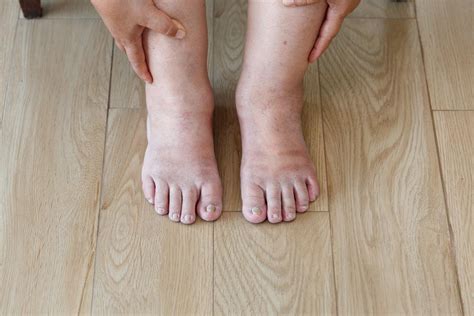 Can May Thurner Syndrome cause symptoms in BOTH legs? - Get Healthy Veins