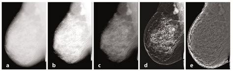 Diagnostics | Free Full-Text | Breast Imaging Physics in Mammography ...