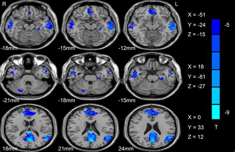 Angular Gyrus Mri