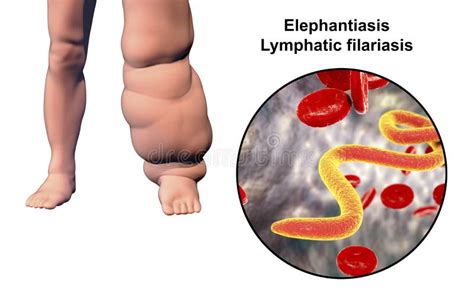 Leg of a Person with Elephantiasis, Lymphatic Filariasis Stock Illustration - Illustration of ...