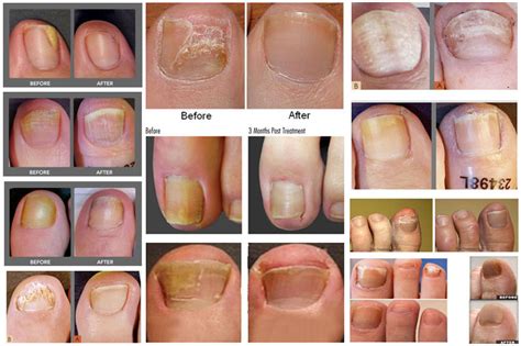 Laser Toenail Fungus Removal, Virginia | Reflections