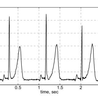 ECG signal recorded with the developed wireless sensor. | Download Scientific Diagram