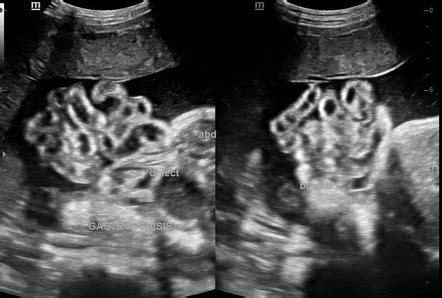 Gastroschisis | Radiology Case | Radiopaedia.org