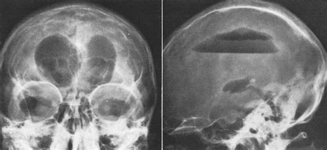 Isotope Cisternography in Hydrocephalus with Normal Pressure in: Journal of Neurosurgery Volume ...