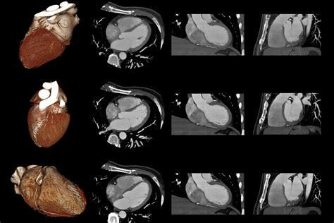 Cardiac CT | Cardiac Computerized Tomography | Capital Area Cardiovascular Associates