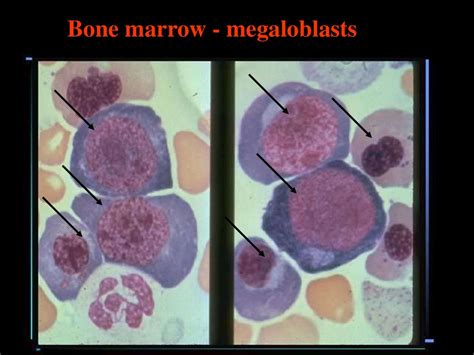 Megaloblastic anemia - online presentation