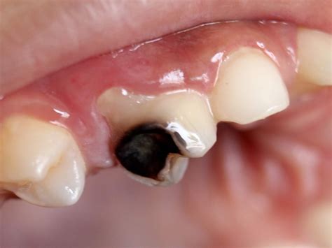 Cavities (Dental Caries). - HEALTH INFORMATION