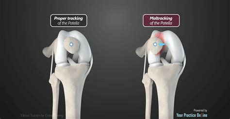 Tibial Tubercle Osteotomy - Michigan Knee Institute