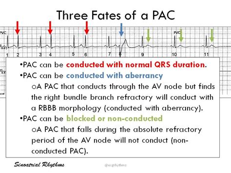 Pin on Basic EKG