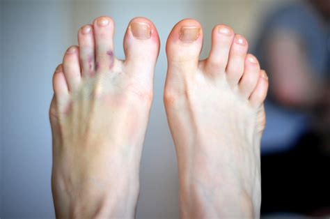 What Are COVID Toes? | FAAWC Blog | Delaware, Ohio Podiatrist