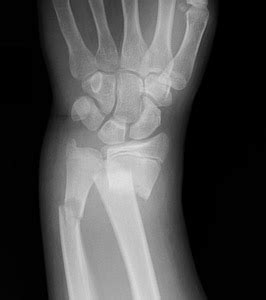 cpt code for orif distal radius and ulna fracture