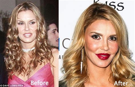 Brandi Glanville plastic surgery before and after fillers - Latest Plastic Surgery Gossip And ...