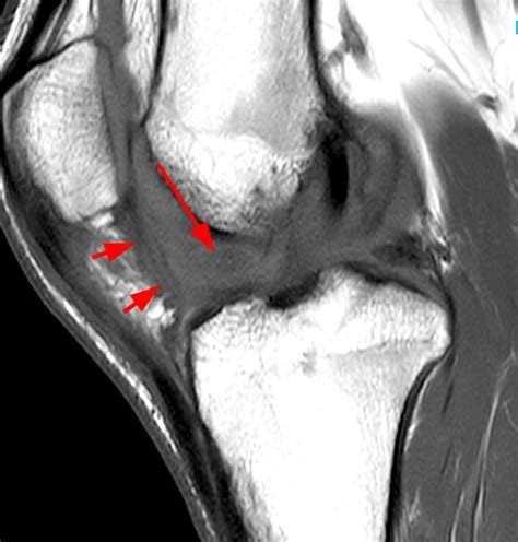 Arthrofibrosis of the Knee - Radsource