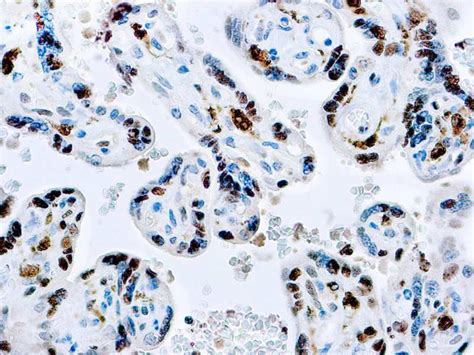 Factor XIII-A | Diagnostic BioSystems - Immunohistochemistry, Primary Antibodies, Monoclonal ...