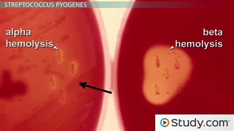 Strep Throat | Definition, Stages & Incubation - Video & Lesson ...