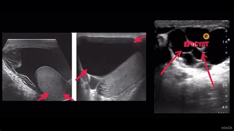 tkr_DDS 05 HYDROCELE VS EPIDIDYMAL CYST🚦 - YouTube