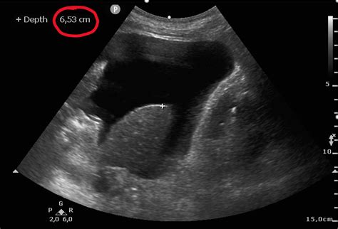 WINFOCUS | Should Ultrasound Guided Paracentesis Be Obligatory For The ...