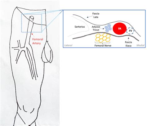 Fascia Iliaca anatomy drawing - ALiEM