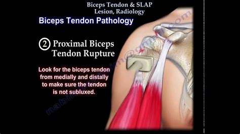 Biceps Tendon & SLAP Lesion Radiology - Everything You Need To Know - Dr. Nabil Ebraheim - YouTube