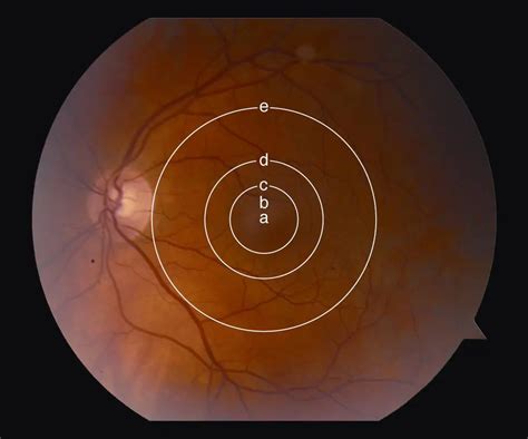 Anatomical macula - American Academy of Ophthalmology