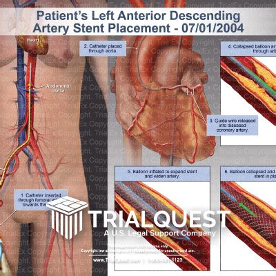 Left Anterior Descending Artery Stent Placement - TrialExhibits Inc.