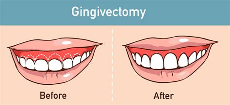 Aesthetic Dentistry-What to Expect with Laser Gum Lift Surgery - Austin ...